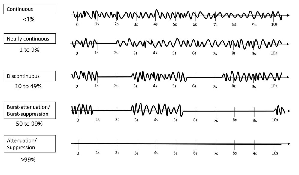 SBeniczky's tweet photo. The new ACNS guideline on cEEG has just been published - now all inclusive: with seizures and status epilepticus too. Lots of useful infographics and examples.
https://t.co/LVkcA8VSCW
#EEG #criticalcare #epilepsy https://t.co/5lQ55HHJNV