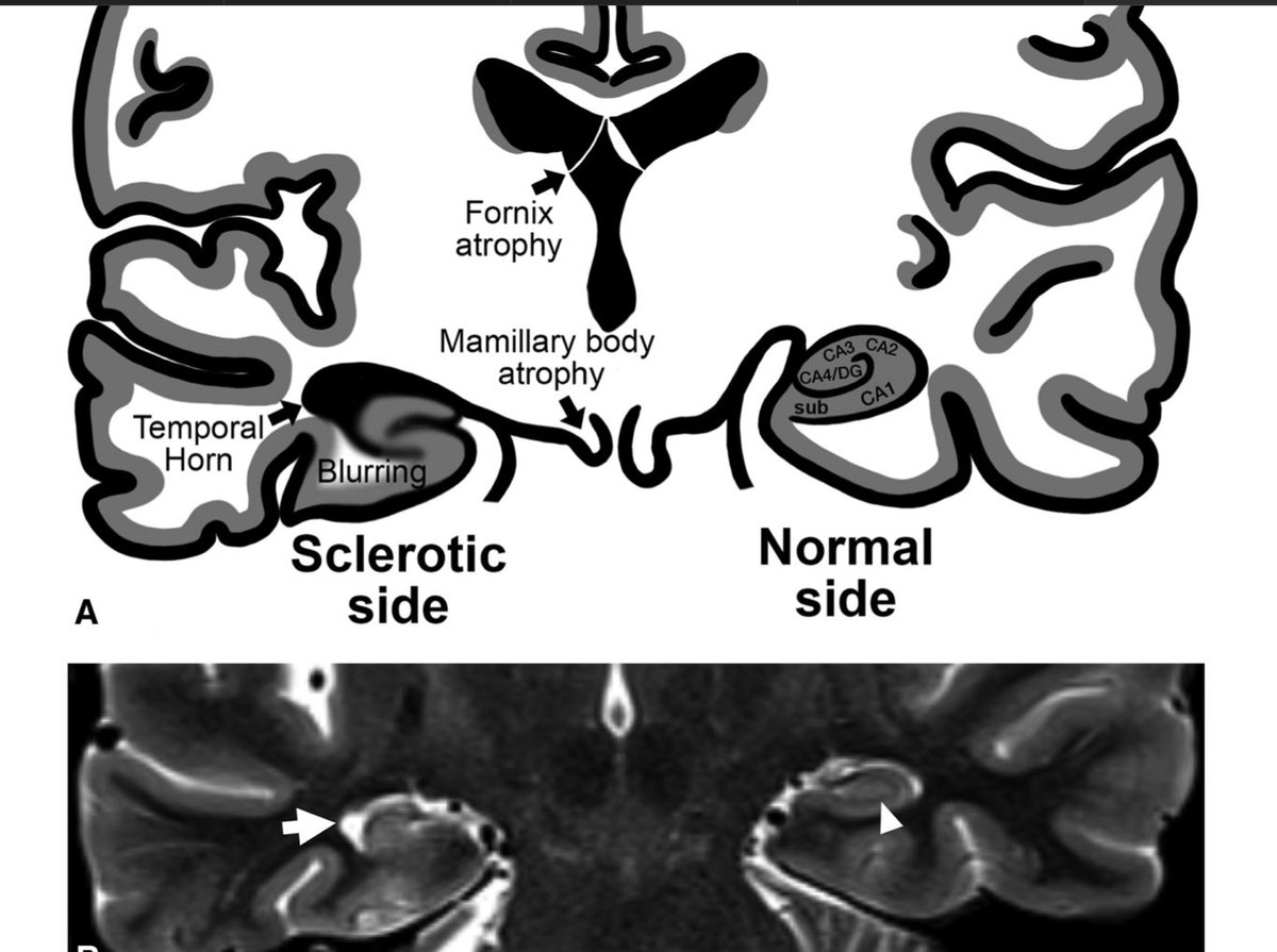 Secondary findings shown in the illustration are ipsilateral fornix and mammillary body volume loss, enlargement of the temporal horn (arrow), and abnormal white matter signal and gray–white blurring at the temporal pole.

dx.doi.org/10.3174/ng.190…