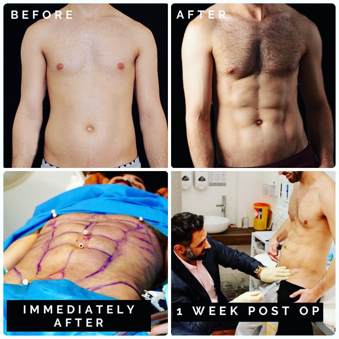 Bellavou's tweet photo. This gentleman had #VaserLiposculpting to chisel and define his abdomen for a more muscular physique. You can see at one-week post-op, he still has some swelling and a little pocket of fluid (which you can see Amir draining). #bellavou #bellavouresults #cosmeticsurgery #lipo https://t.co/6MLbaINXXy