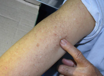 Ketiga, lengan gw ada bintik-bintik merah yang semakin ke sini semakin ilang. Pokoknya kulit jadi lebih clear. Gua punya alergi misterius yang keluar tiap 2 hari sekali dalam bentuk gatal sebadan. Sejak keto dan intermitten fasting (IF), jadi 3-4 hari sekali, keparahan berkurang.