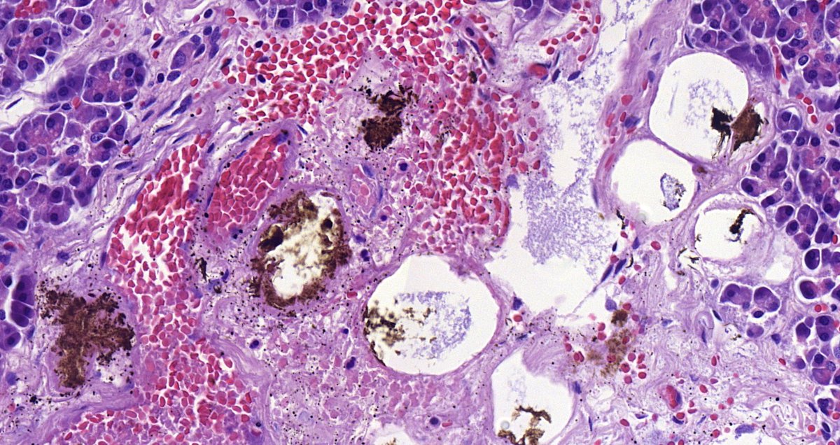 nucleololailo's tweet photo. Whipple resection by supposed cyst in the uncinate process connected to the Wirsung..macroscopically I only saw a dilated, ectatic wirsung with normal epithelium and subepithelial hemorrhage..but I am puzzled by these yellow-brownish deposits..any idea? #gipath #pancreas https://t.co/Jl5tXVwjtt