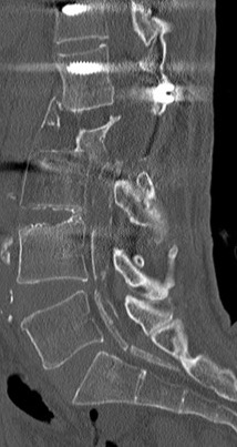 Jessica Wen, MD (@jessicajwen) on Twitter photo When a non-con lumbar spine CT accidentally looks like a myelogram. Remote hx of L2 burst fracture and surgery. Bulky calcifications of the dura and intradural contents surrounding and compressing the nerve roots. Dramatic case of arachnoiditis ossificans! <a href="/CLTRadiology/">Charlotte Radiology</a> @US_Rad When a non-con lumbar spine CT accidentally looks like a myelogram. Remote hx of L2 burst fracture and surgery. Bulky calcifications of the dura and intradural contents surrounding and compressing the nerve roots. Dramatic case of arachnoiditis ossificans! <a href="/CLTRadiology/">Charlotte Radiology</a> @US_Rad