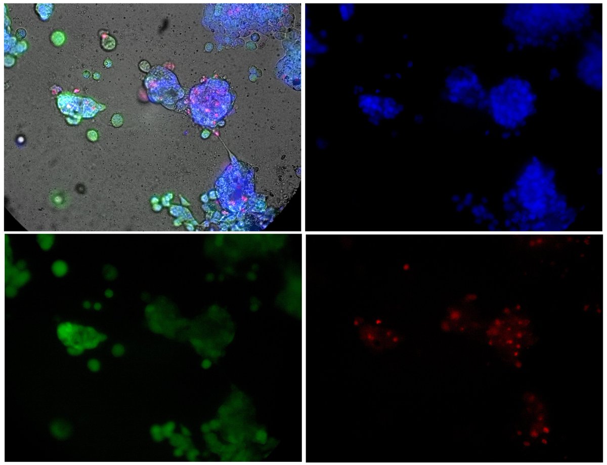 RealResearch3's tweet image. Check how triple staining looks like on cancer cells growing on our LifeGel!

Staining performed using:
· Hoechst – blue (estimation of cell number)
· Calcein AM - green (living cells)
· Propidium Iodine -red (dead cells)

#3Dcellcultre #LifeGel #microscopy