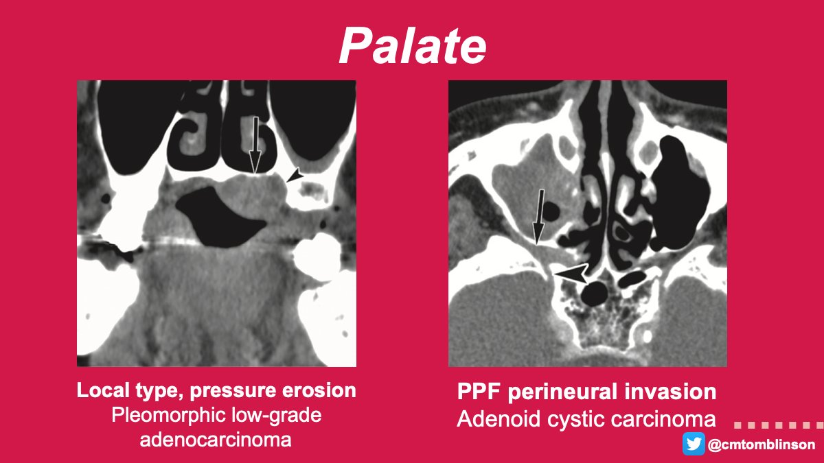 The hard-soft palate junction is most common site & MEC > ACC. These may cause pressure erosion (localized) or destruction of hard palate or pterygoid plate (invasive). PNS can extend to pterygopalatine fossa (PPF), foramen rotundum, cavernous sinus, & Meckel’s cave. 6/12 #RGphx