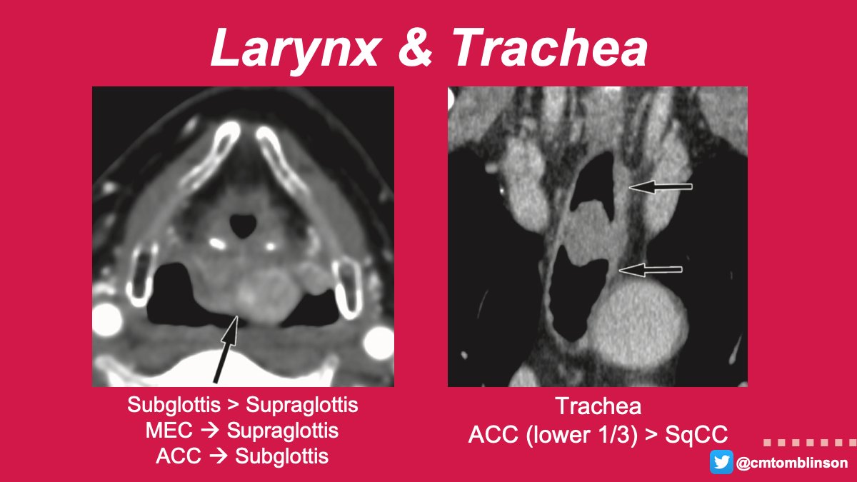 In the larynx, glands are absent along the free edge of the membranous vocal fold, which can be helpful in distinguishing from SqCC. In the trachea, patients can be asymptomatic until the lumen is narrowed by 50%, then present with symptoms of airway obstruction. 10/12 #RGphx