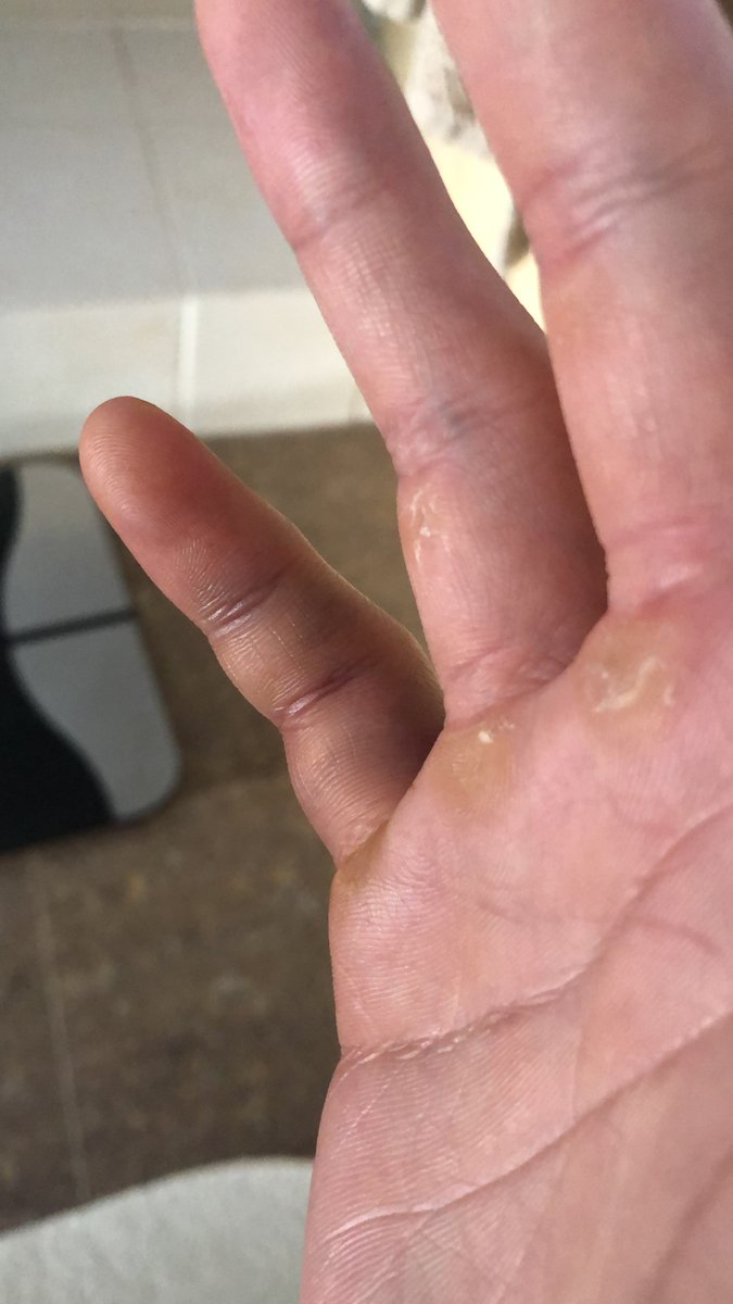 The day that COULD’VE ruined me ...This is about a goof and a pinky sprain. (Just a pinky, but interesting story ...) 