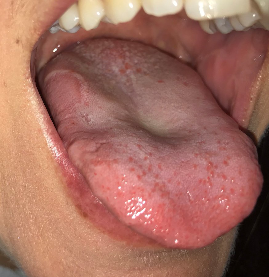 What is COVID tongue? Swollen, sore tongue may be possible coronavirus symptom