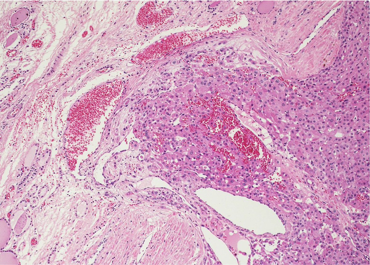TimBell_Path's tweet photo. Follicular carcinoma can resemble adenoma at low power.  Very important to assess presence of capsular or vascular invasion.  Cellular atypia and necrosis, while potentially present, are not sufficient to make the diagnosis @KMirza #TwitterHomework https://t.co/jZtQ4PzRDc