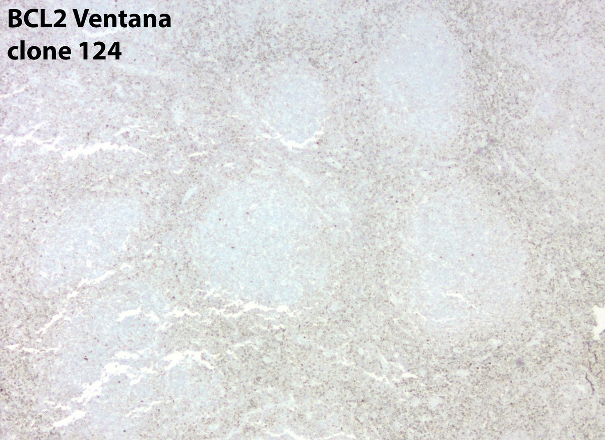 jake_bledsoe's tweet image. Some follicular lymphomas may appear to be BCL2-negative with commonly used IHC antibodies. Some of these cases have mutations in BCL2 that impact protein detection. Alternate BCL2 clones may be useful, as in this case.

onlinelibrary.wiley.com/doi/full/10.10…

#pathology #hemepath