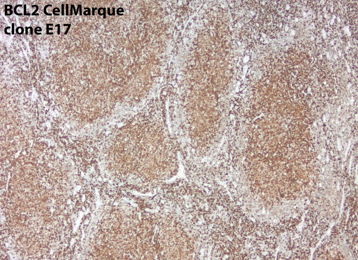 jake_bledsoe's tweet image. Some follicular lymphomas may appear to be BCL2-negative with commonly used IHC antibodies. Some of these cases have mutations in BCL2 that impact protein detection. Alternate BCL2 clones may be useful, as in this case.

onlinelibrary.wiley.com/doi/full/10.10…

#pathology #hemepath