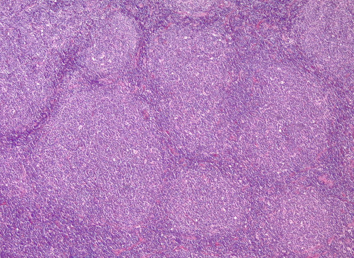 jake_bledsoe's tweet image. Some follicular lymphomas may appear to be BCL2-negative with commonly used IHC antibodies. Some of these cases have mutations in BCL2 that impact protein detection. Alternate BCL2 clones may be useful, as in this case.

onlinelibrary.wiley.com/doi/full/10.10…

#pathology #hemepath
