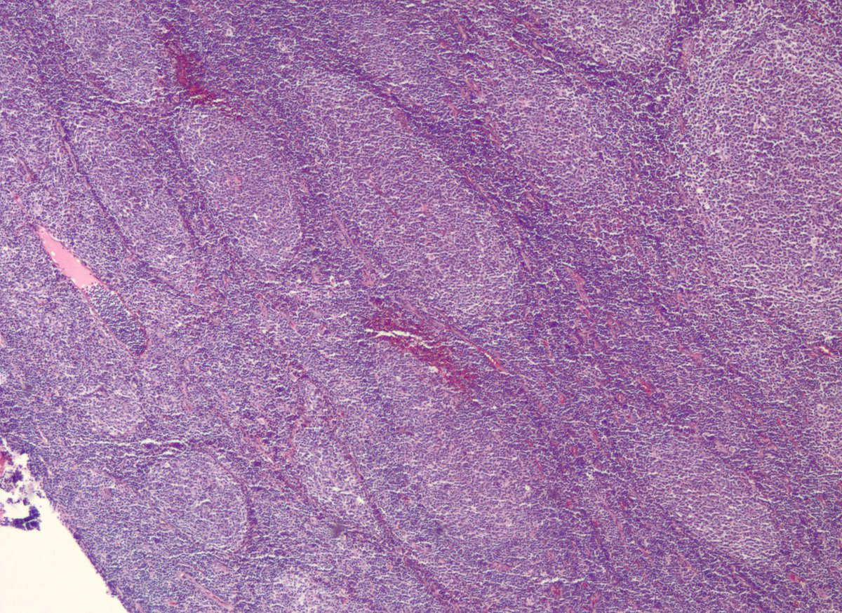 jake_bledsoe's tweet image. Some follicular lymphomas may appear to be BCL2-negative with commonly used IHC antibodies. Some of these cases have mutations in BCL2 that impact protein detection. Alternate BCL2 clones may be useful, as in this case.

onlinelibrary.wiley.com/doi/full/10.10…

#pathology #hemepath