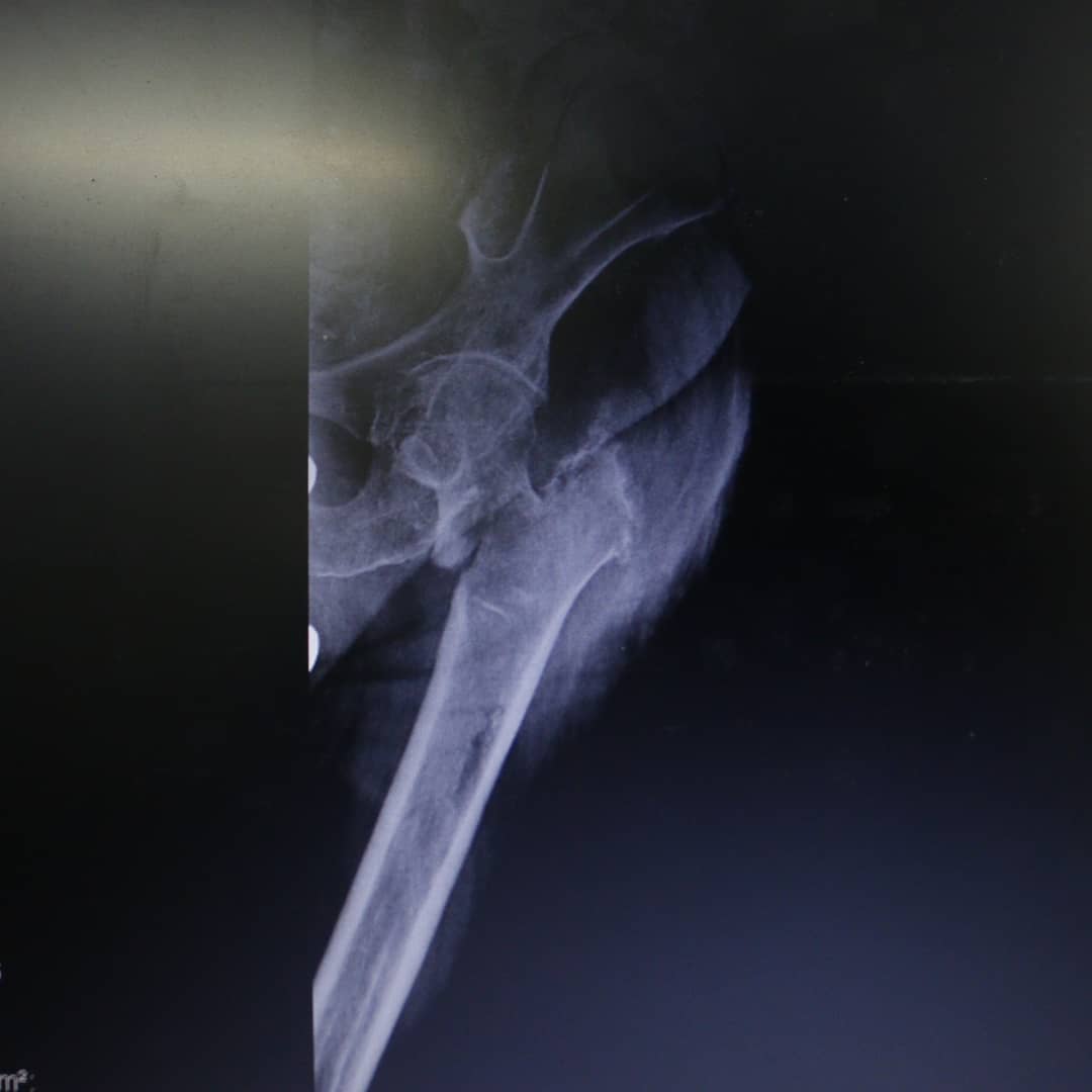DrPretell's tweet photo. Paciente con #fractura basicervical de #fémur antigua, le realizamos una reducción cruenta más #osteosíntesis con placa – tubo más #osteotomía, procedimiento para este tipo de #cirugías, logrando la recuperación de la funcionalidad y caminar normalmente. #Ortopedia #Traumatología https://t.co/cppWHbXQ3a