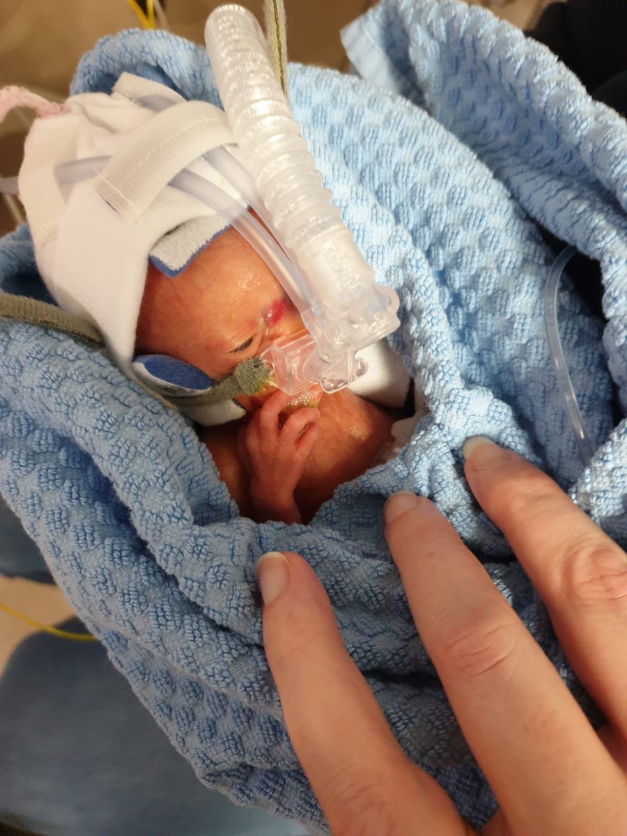 BrendaDonohue's tweet image. This is Roisin born at 29 weeks @_TheNMH weighing less than 1lb.She has been getting donor Breast milk + is now 4lbs! @RTECountryWide @RTERadio1 8am I follow the milk supply chain and see if #Brexit has effected it. I chat to @LouiseLennox_ #bloodbikers + Roisin’s mum #fullcircle