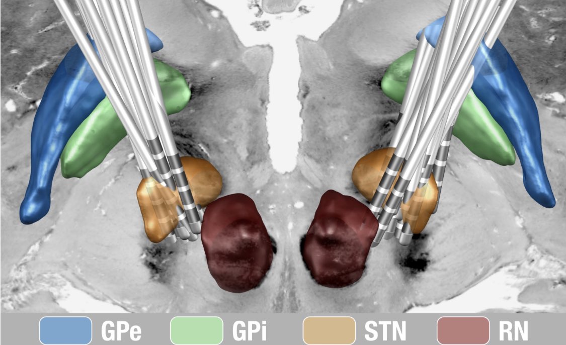 andreashorn_'s tweet photo. Analyzing network effects of DBS using fNIRS has the huge advantage of no stimulation artifacts. Schumacher et al. explore this &amp; show effects of DBS on PFC organization as a function of disease onset. Relevant for understanding cogn. decline in PD/DBS.

https://t.co/CyEYzrXfD0 https://t.co/JZRmi7phzL