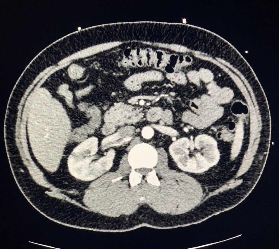 GregZahn's tweet image. Sudden onset flank pain. When it feels like his previous kidney stone, but it’s not. “January 2021 US Case” by @IUEM_ultrasound on #Vimeo vimeo.com/503226104?ref=…