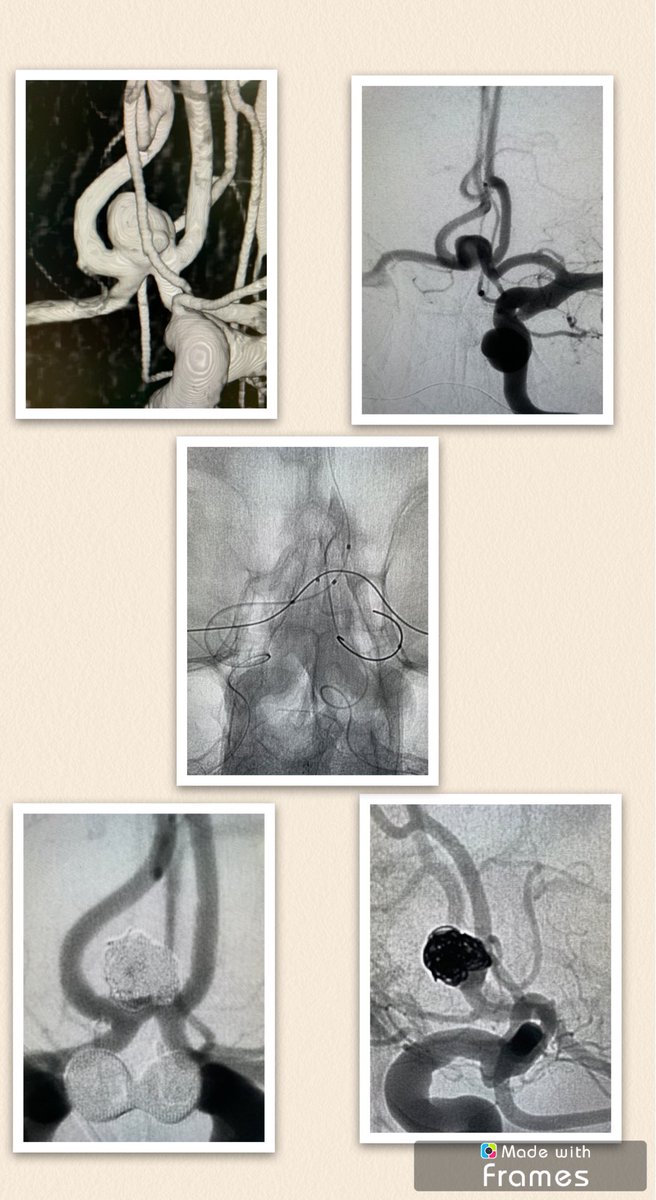 Miguel A. (@ma_castano_bl) on Twitter photo Why I love remodeling <a href="/YerayAguilar/">Yeray Aguilar</a> <a href="/GENI_NRXI/">!</a> <a href="/CxNeuro/">NeuroInterventionCx</a> <a href="/saludsalmantina/">ꑄꋬ꒒ꀎꂟ ꑄꋬ꒒ꂵꋬꂚ꓄꒐ꂚꋬ🚑🏥🏪</a> <a href="/BaltSpain/">Balt Spain Medical</a> Why I love remodeling <a href="/YerayAguilar/">Yeray Aguilar</a> <a href="/GENI_NRXI/">!</a> <a href="/CxNeuro/">NeuroInterventionCx</a> <a href="/saludsalmantina/">ꑄꋬ꒒ꀎꂟ ꑄꋬ꒒ꂵꋬꂚ꓄꒐ꂚꋬ🚑🏥🏪</a> <a href="/BaltSpain/">Balt Spain Medical</a>