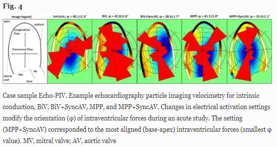 Ahhh, that Friday feeling. Let's celebrate with a new #JICE #FreeRead: Impact of synchronous atrioventricular delay optimization on left ventricle flow force angle evaluated by echocardiographic particle image velocimetry #cardiotwitter rdcu.be/cd3zN