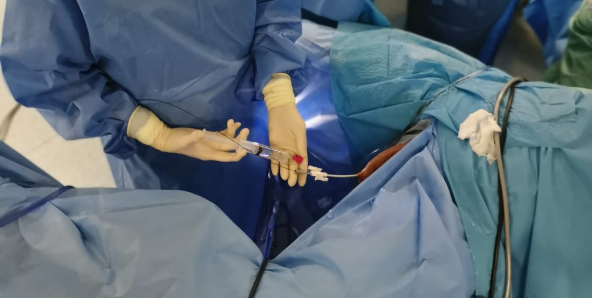 GuidoGiusti's tweet photo. A good feature of @Rocamed1 #uas #biflex is just that .. its inner stylet may act also as dual lume catheter so that while passing it up along the safety #guidewire contrast medium can be injected thru the 2nd way .. very useful in tricky cases and also cost effective! https://t.co/LG8zNWisK3