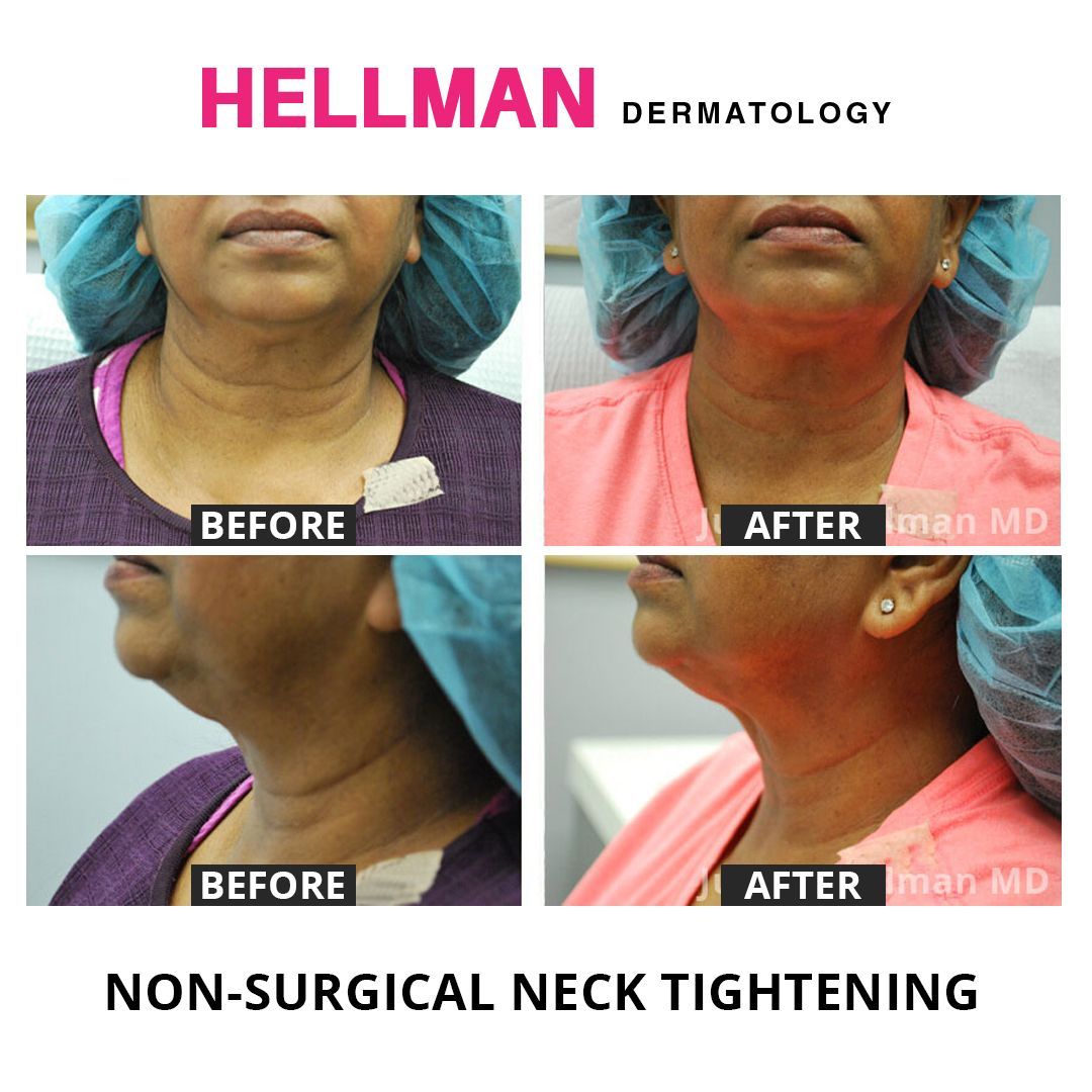 Dr. Hellman uses Morpheus8, Evoke and Sculpsure to tighten and lift sagging necks. Her non-surgical double chin removal treatment is a safe, fast and effective way to achieve tighter, youthful results for dark and light skin tones.
#nonsurgicalnecklift #morpheus8 #fractora