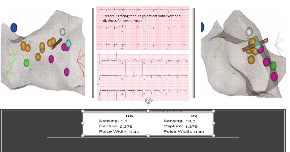 #DontDisTheLBB a case from last January. The pt told me today, "it changed my life." She made me happy.