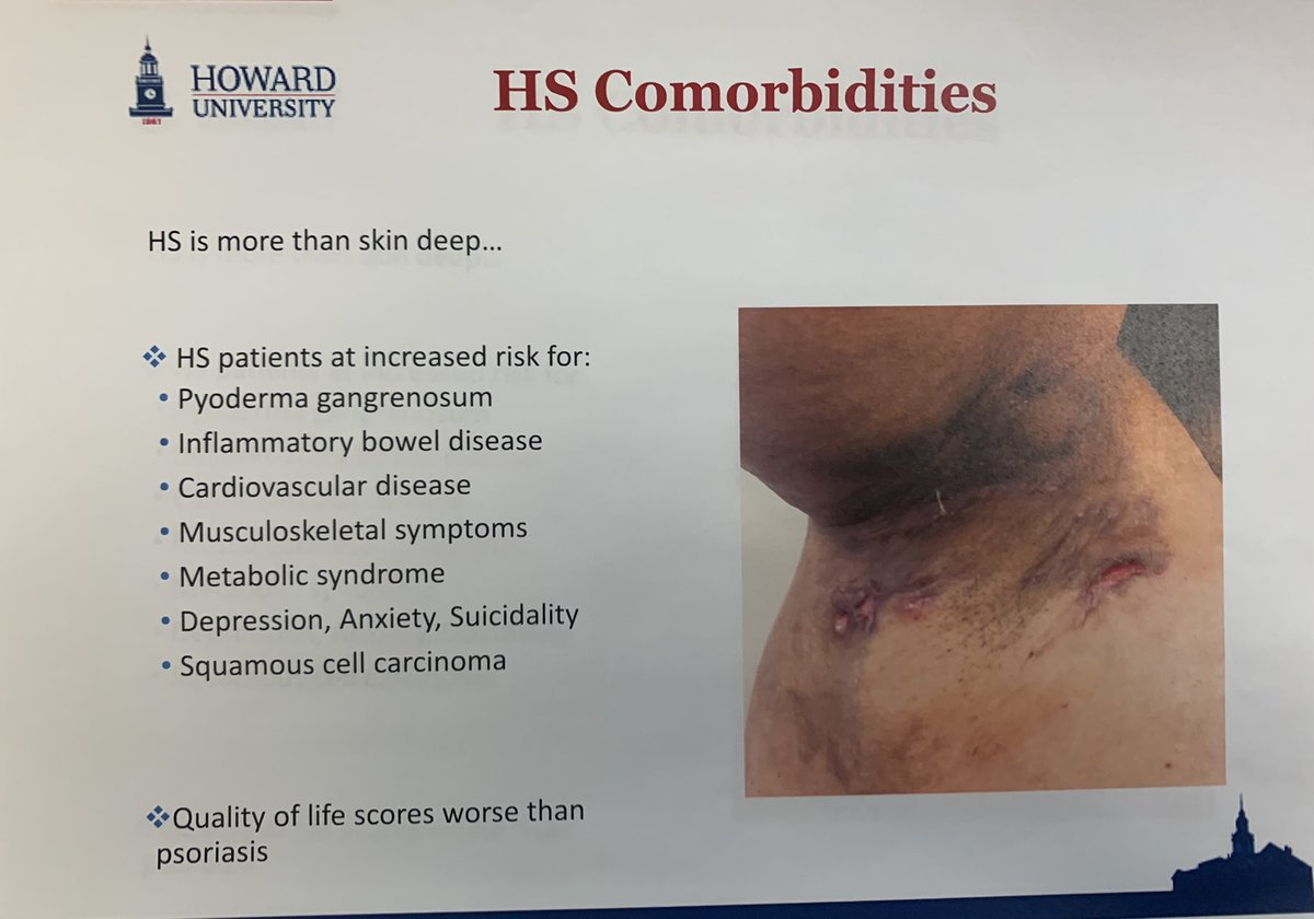 Clinical Pearl of the Day # 2 from Lankenau Virtual Grand Rounds with @GinetteOkoye: Hidradenitis Suppurativa: the Bottom Line <a href="/swarthmoredoc/">William Surkis</a> <a href="/empirederm/">Brian Raphael, M.D.</a> <a href="/S_Panaccione/">Sophia Panaccione</a> @SophiaCedola @tomoliveronc <a href="/MelissaRubin17/">Melissa Rubin</a> <a href="/katz_do/">Richard Katz DO</a> @DrRitiPatel <a href="/EricStarFox/">Eric Fox</a> <a href="/kristamisaac/">Krista Isaac</a> <a href="/IceTeaMD/">Isaac Tea</a>