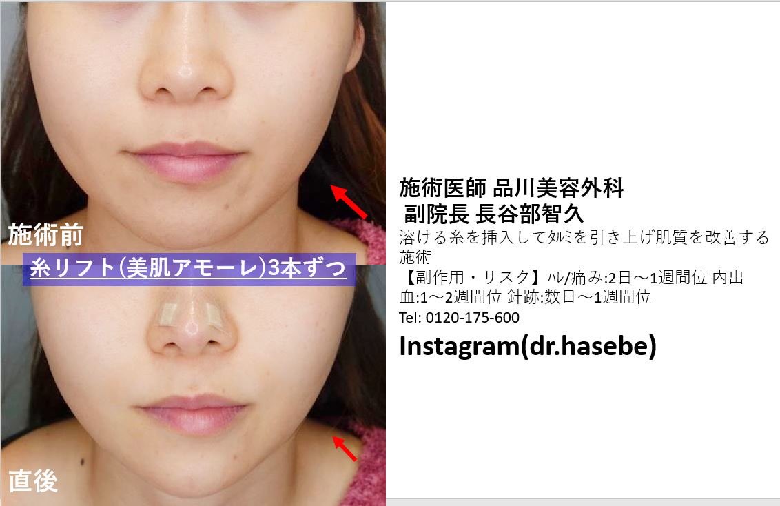 糸リフト クマ取り 品川美容外科 渋谷院 第一副院長 長谷部智久 Drhasebe Twitter