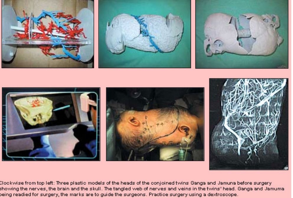 WalterNepal's tweet photo. The story of Ganga Jamuna - the conjoint twins from Nepal who were successfully seperated  by a team of doctors.  This is Dr Basant Pant's account on how the operation was done.
Have a good read! 
#Neurosurgery
#craniophagus
#neurocirurgia
https://t.co/1eB3EiGOj5 https://t.co/QZM9YuUtL4