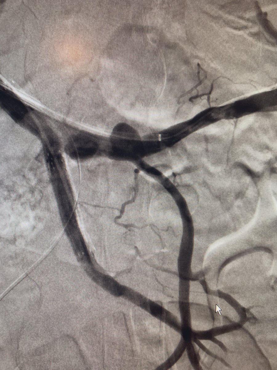 USC IR (@usc_ir) on Twitter photo Interesting findings - pancreatitis c/b pseudoaneurysms of the smv and splenic vein. I believe the correct term is “explosion” of the smv. How would you treat? Will post f/up @rkryu <a href="/SIRspecialists/">Society of Interventional Radiology</a> <a href="/TherealDoctorJ/">Jenanan Vairavamurthy, MD</a> <a href="/IR_RayRay/">Ray Ter-Oganesyan</a> <a href="/SDhandMD/">Sabeen Dhand</a> <a href="/uclaVIR/">UCLA IR</a> <a href="/MountSinaiIR/">Mount Sinai IR</a> <a href="/nyuVIR/">NYU VIR</a> Interesting findings - pancreatitis c/b pseudoaneurysms of the smv and splenic vein. I believe the correct term is “explosion” of the smv. How would you treat? Will post f/up @rkryu <a href="/SIRspecialists/">Society of Interventional Radiology</a> <a href="/TherealDoctorJ/">Jenanan Vairavamurthy, MD</a> <a href="/IR_RayRay/">Ray Ter-Oganesyan</a> <a href="/SDhandMD/">Sabeen Dhand</a> <a href="/uclaVIR/">UCLA IR</a> <a href="/MountSinaiIR/">Mount Sinai IR</a> <a href="/nyuVIR/">NYU VIR</a>