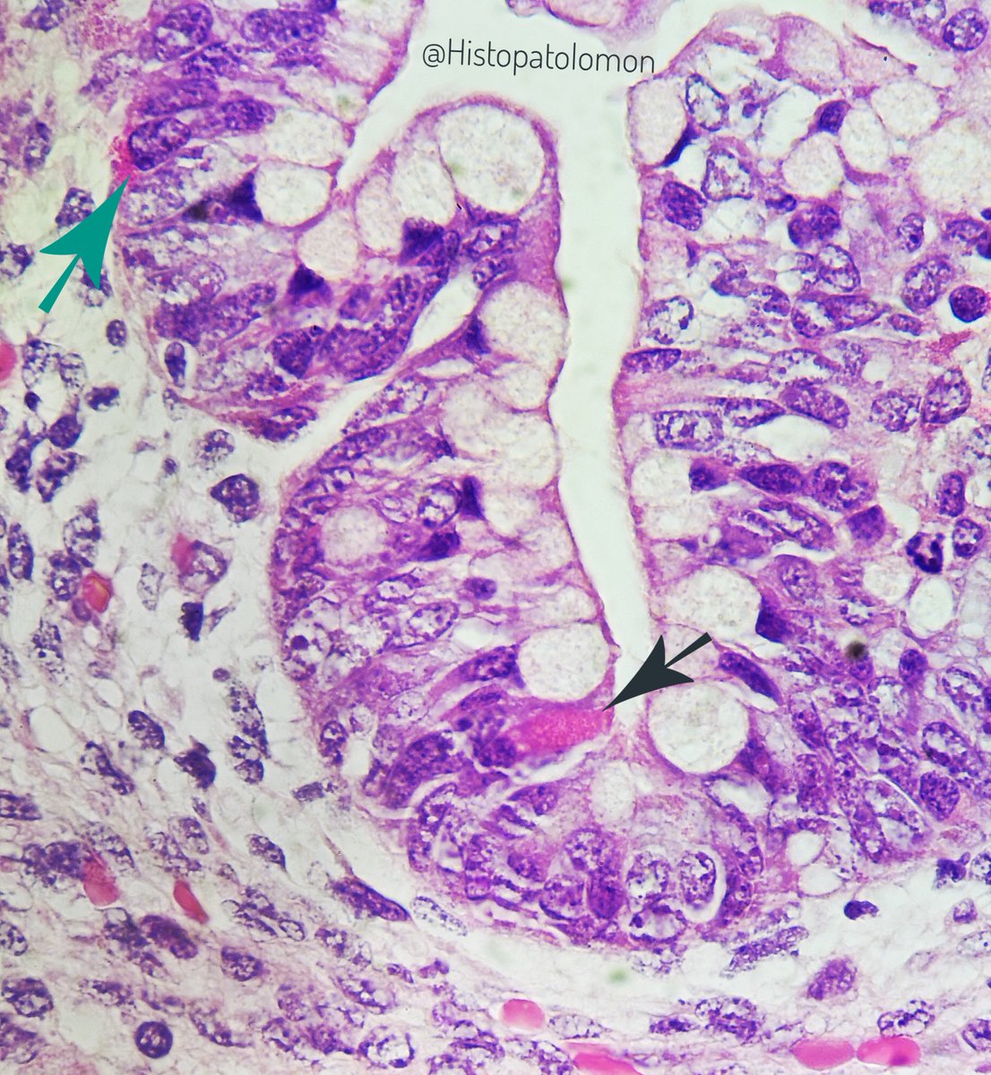 An endocrine cell, with its subnuclear granules (green) and a Paneth cell, which is exocrine, with the granules in the apical pole and contacting the lumen where it discharges the granules (black).I think it's early differentiation into Paneth cells at 13 wk. what do you think?