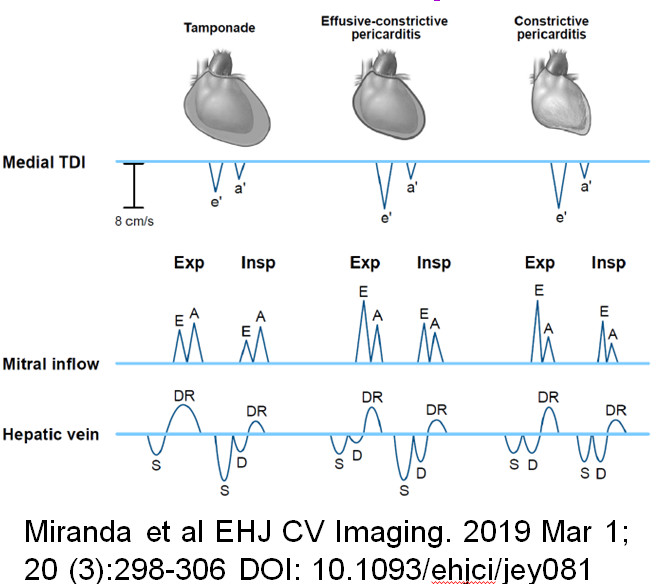 Beautiful study of ECP <a href="/NephroP/">NephroPOCUS</a> Hepatic V Doppler confirms constriction. Few differences in Doppler between tamponade , ECP, and CP below. e' is not as high in tamponade and ECP as CP. Pure tamponade has gr 1 mitral inflow. Steroid if dialysis does not work. @jamil_tajik <a href="/ASE360/">American Society of Echocardiography</a>