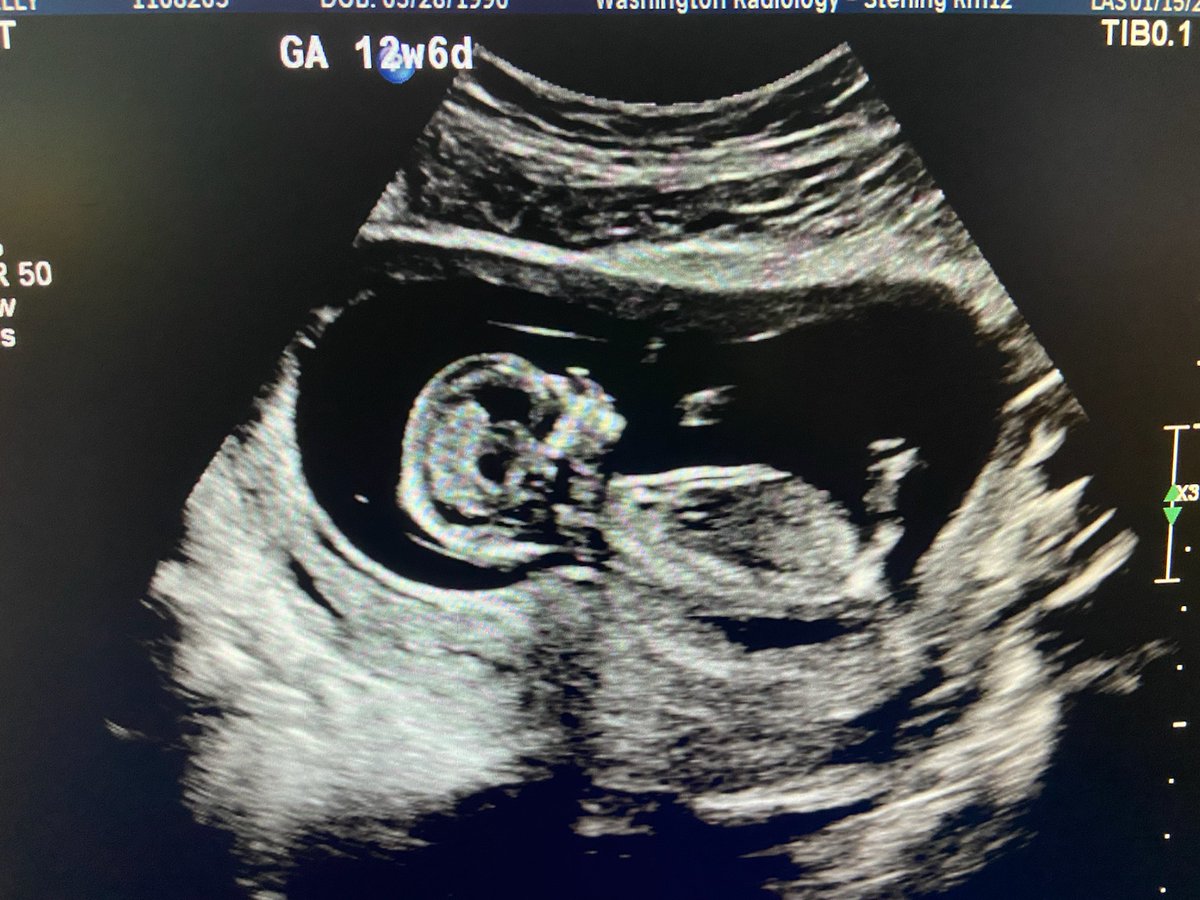 burtc74's tweet photo. Kelly and I are very excited about the new addition coming to our family. James Albert Burt will be here in July. https://t.co/JvwifeK4kL