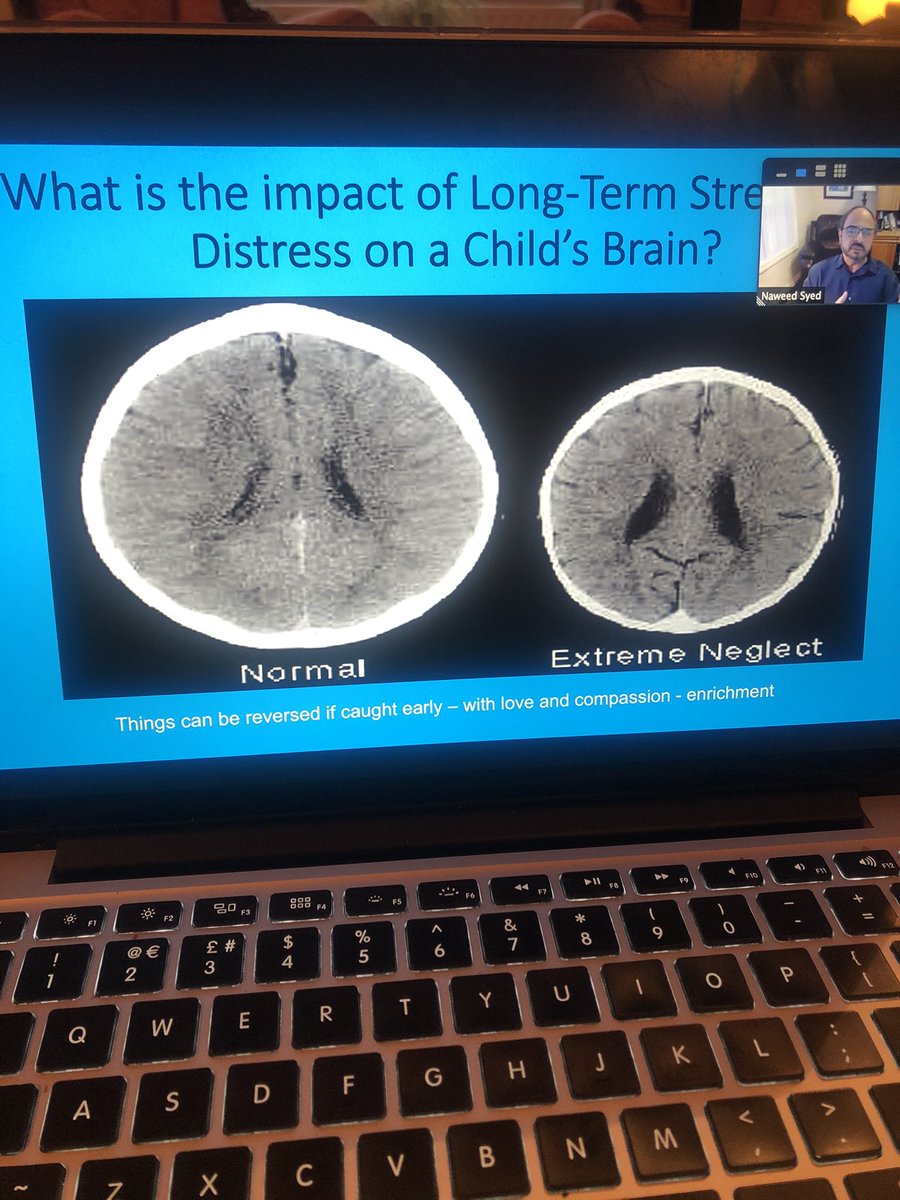 Impact of long-term stress on a child’s brain.