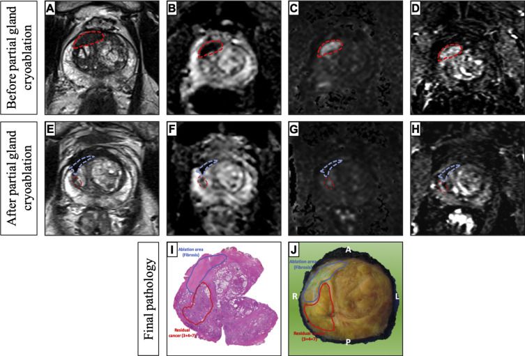 EUplatinum's tweet photo. February 2021 Issue

Need for Systematic Magnetic Resonance Imaging Interpretation and Reporting after Partial Prostate Gland Ablation 
https://t.co/uOdnjigTPA https://t.co/IujT1oJelo
