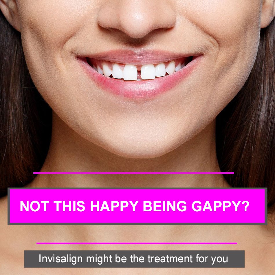 DentaISolutions's tweet photo. If you have gaps between your teeth, Invisalign can certainly be an option for you. With our free consultation, we’ll be able to examine your teeth and determine which Invisalign treatment would be most suitable for you. https://t.co/Gt4iuCOhWT