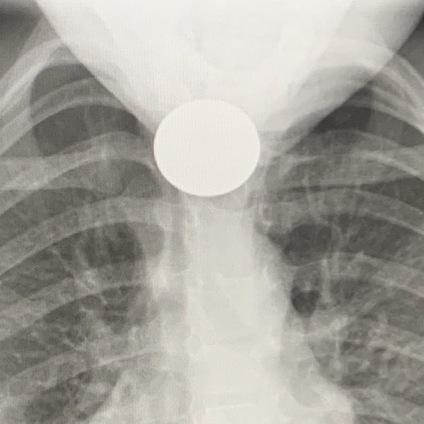 WilliamRBlythe's tweet photo. Coin lodged at the cricopharyngeus in 2.5 year old. Takes about 10 seconds to remove it, but needs to be done expediently and with careful attention to secure the airway. #GeneralENT #ENTLife https://t.co/1Jk3v7tEUq
