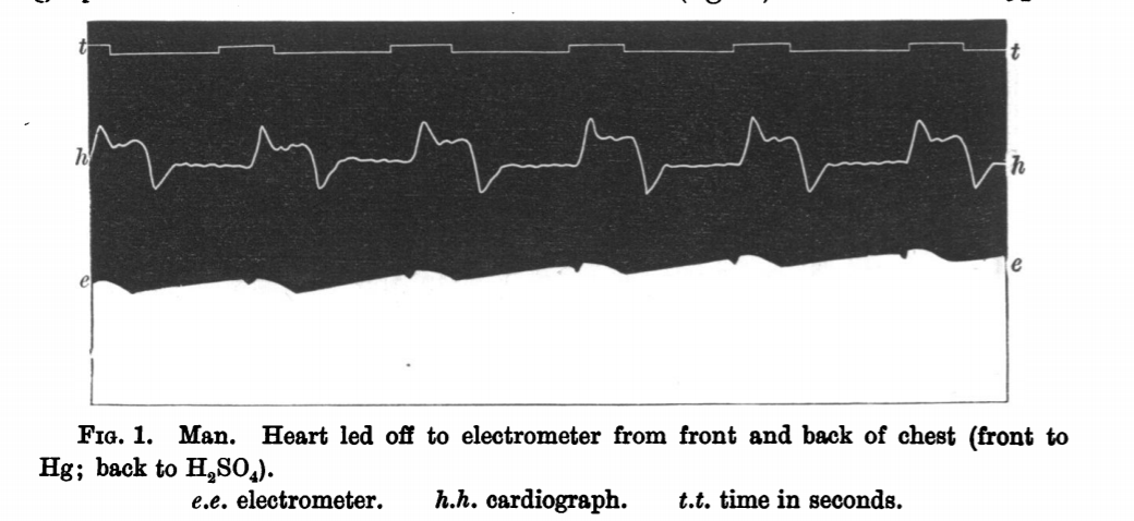 He first used this recording method in May 1887. This time the electrodes were attached to the front and back of the subject's chest. NB the ECG is the lowest of the three traces on this graph: the top line records time, the middle is the pulse wave recorded by a sphygmometer.