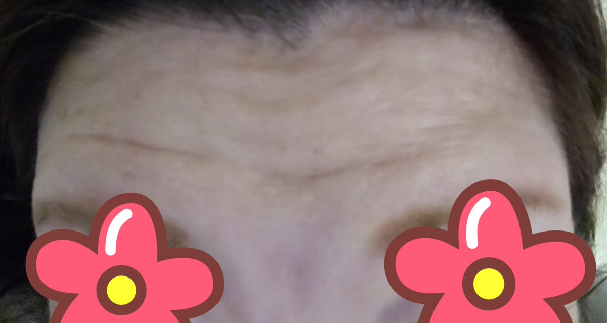 おでこのしわ おでこのしわ