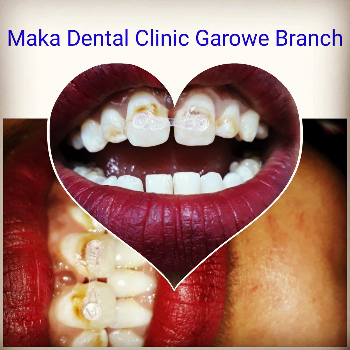 MAKADENTALCLIN1's tweet photo. Hadii aad lahan jirtey Fanax birana horey usoo xiratey kuguna soo laabatey fanaxdii, waan kuu heynaa Xalkeeda adigoon birana markale  xiran ee horey ugaar xarunta Casriga ah ee Maka Dental Clinic Garowe_Branch 
Contacts: 0906869494 ama whatsp +252615512168  +252907367384 https://t.co/ATNoi8jVfF