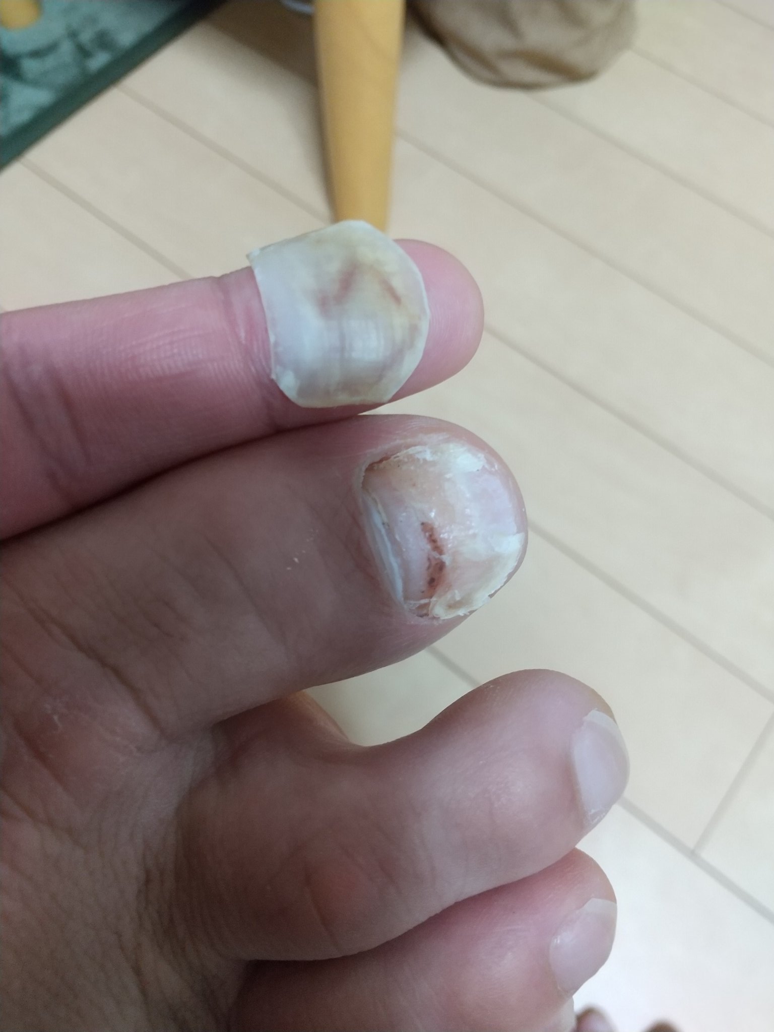 まごころ 志賀高原で痛めた足の爪が 綺麗に剥がれた 爪の中が膿んで 変な汁出て痛かったなぁ 逆に側の親指の爪も真っ黒で 生え変わり中 T Co Au2drd7z Twitter