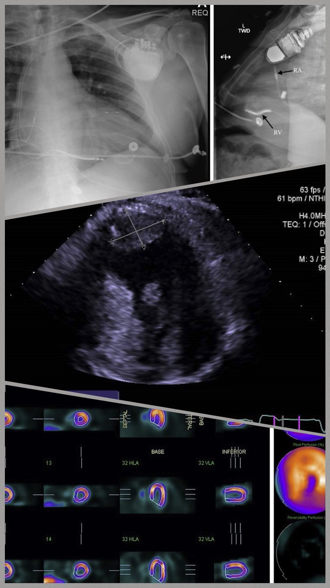 CASEfromASE's tweet photo. 🤔Are you looking for an avenue to view interesting #echofirst cases❓Take a peek  🤓 at the newest addition of CASE https://t.co/NaEWiMr4xI and see great cases like this 👇Apical Thrombus Formation Post CRT Therapy  @ASE360 https://t.co/XFoxJBUnTP