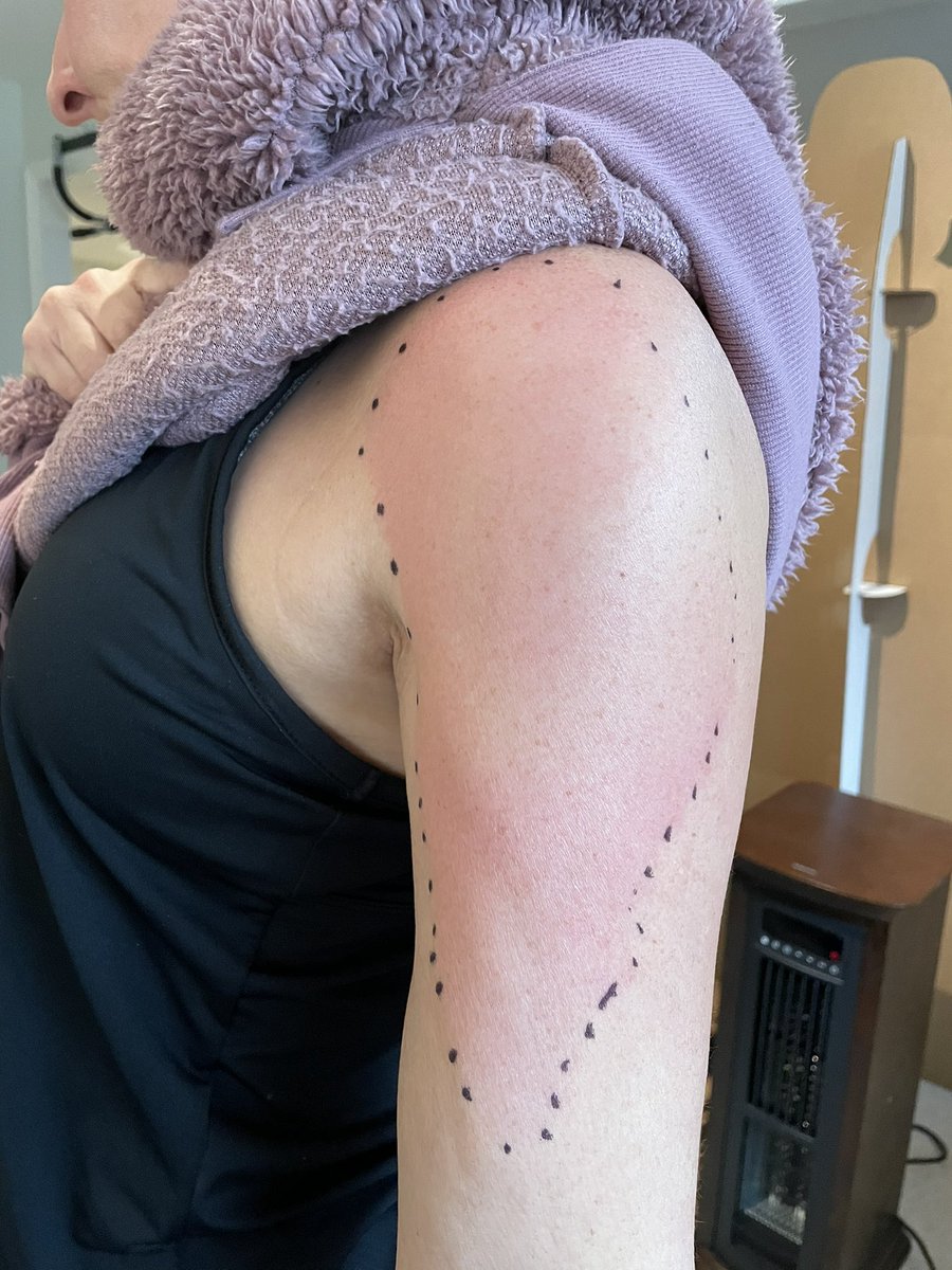 aevuns's tweet photo. Anyone else having a delayed reaction to the @moderna_tx vaccine? This started a week after the first jab and is getting bigger. Temp of the area has been between 99.7 and 102.9. Do we need to be concerned for more severe reaction? https://t.co/cibaZtpXX1