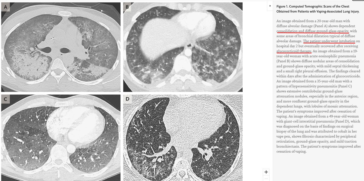 TruthCovid19's tweet photo. Dear Doctors @DrTravisScott @JeffreyKanneMD
 
In October 2019 you reviewed several imaging of EVALI cases: https://t.co/SWdd7ggt81

Have anyone tested these samples from SARS-CoV-2? Do you have any plans to review them from a COVID point of view?

#EVALI #COVID19 #pathologists https://t.co/Al6F59bFz6