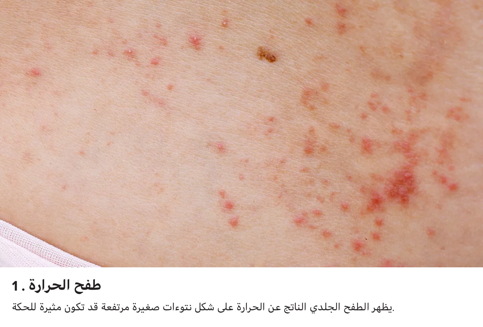 صالح للأكل رافعة إبرة علاج الحرارة الجلدية Deryamaksanltd Com