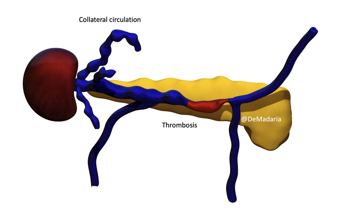 Sinistral portal hypertension has been described in 7% of patients with chronic pancreatitis (CP), 35% of them develop gastroesophageal varices  https://pubmed.ncbi.nlm.nih.gov/10773149/&nbsp; Bleeding due to esophageal/gastric varices is uncommon, more frequent in alcoholic CP  https://pubmed.ncbi.nlm.nih.gov/32800648/&nbsp;