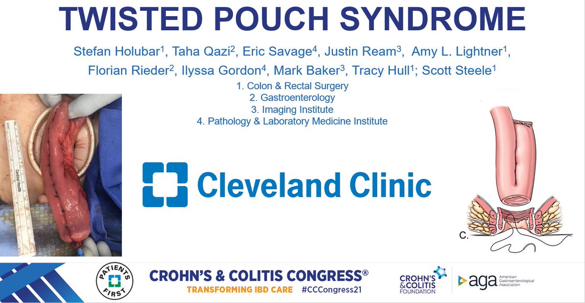 HolubarStefan's tweet photo. Twisted Pouch Syndrome Triad: 1 obstr symp (SBO/obstr defec) 2 erratic bowels (mimics pouchitis) 3 unexplained abd pain (req opioids)...pts Rx’d w biologics & surgery b4 referral @ClevelandClinic #IPAA center #IBD #SoMe4Surgery #SoMeIBD @CrohnsColitisFn @CCfdnNEOhio @CleClinicMD https://t.co/zmbm54mpMa
