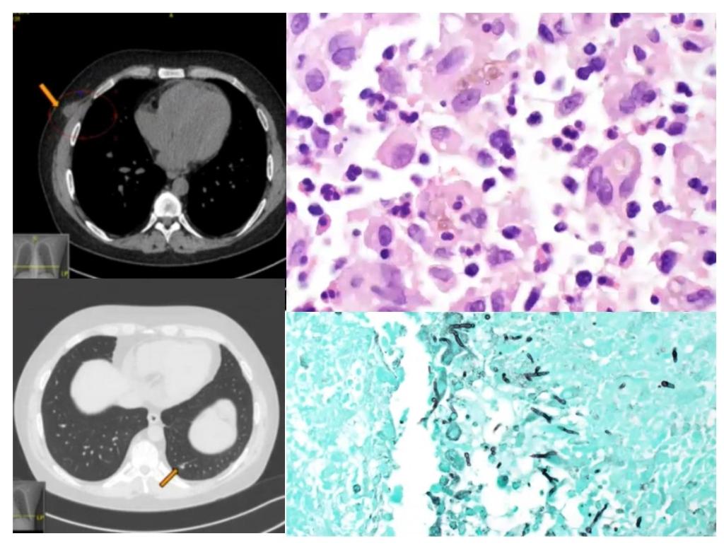 Images of Infectious Diseases 4 years after kidney transplant Chest wall mass x 2 mo and new