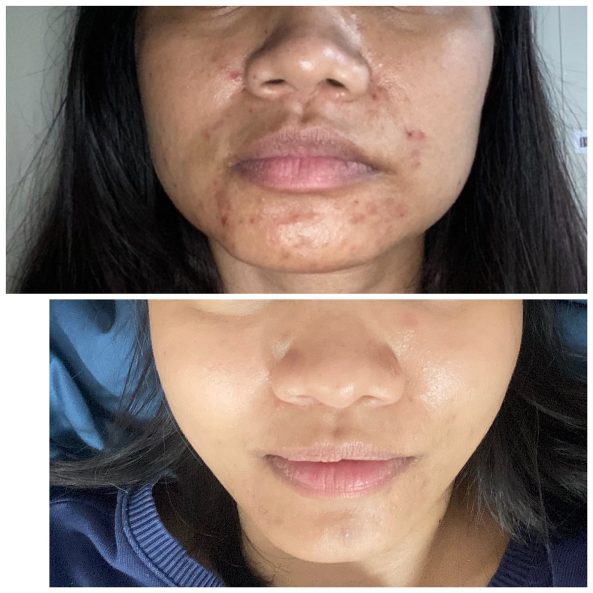 Ji3w's tweet photo. รีวิวรักษาสิวด้วย laser(isolaz+vbeam) ระยะเวลาในการรักษา 6 เดือน ข้อดี ไม่ต้องทายา ไม่ต้องกินยา หวังผลได้ ข้อเสียแพง ถ้าไม่ทำทุกเดือนสิวจะกลับมาใหม่ ต้องมีเงินเปย์ถึงจะสวยตลอดไป 🤣 ค่าใช้จ่าย แล้วแต่คลีนิค เราทำที่ the Demis Siam ซื้อคอร์ส ตกครั้งละหมื่นสอง ทำทุกเดือน #รักษาสิว https://t.co/kEeJfz3CVo