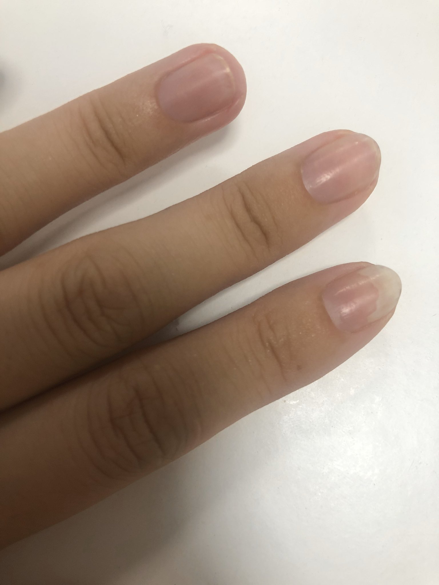 ぽこ 育爪 ネイルケアに興味があり 記録 ネイル関係用にアカウント作りました 19年秋に爪甲剥離症 になり ジェルをやめ セルフネイルしていましたが除光液を頻繁に使うのも となり そこから何もしていませんでした ケアさえせず 爪甲剥離は治り