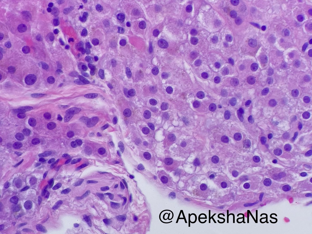 ApekshaNas's tweet photo. Hilus cells
🧩Present in ovarian hilum
🧩Seen in fetal stage and reappears in puberty
🧩May have Reinke crystals
🧩Produce steroids 
#gynpath #pathpearls #pitfallalert #Primer4Pgy1 https://t.co/aUHsCKY12w